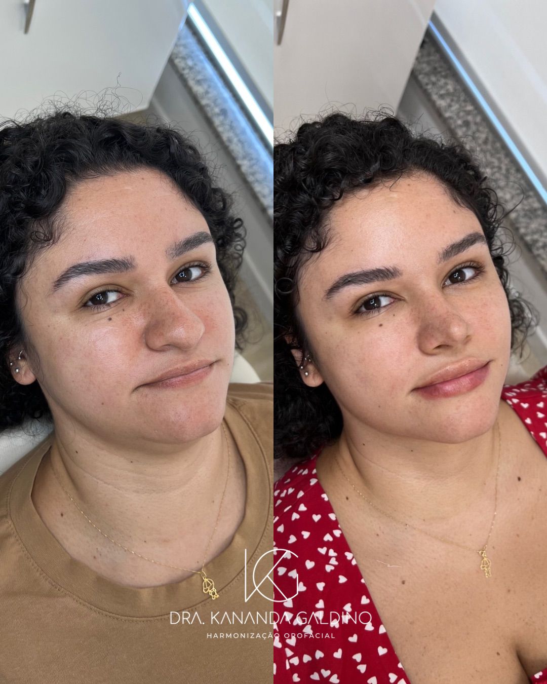 Rinomodelação Estruturada